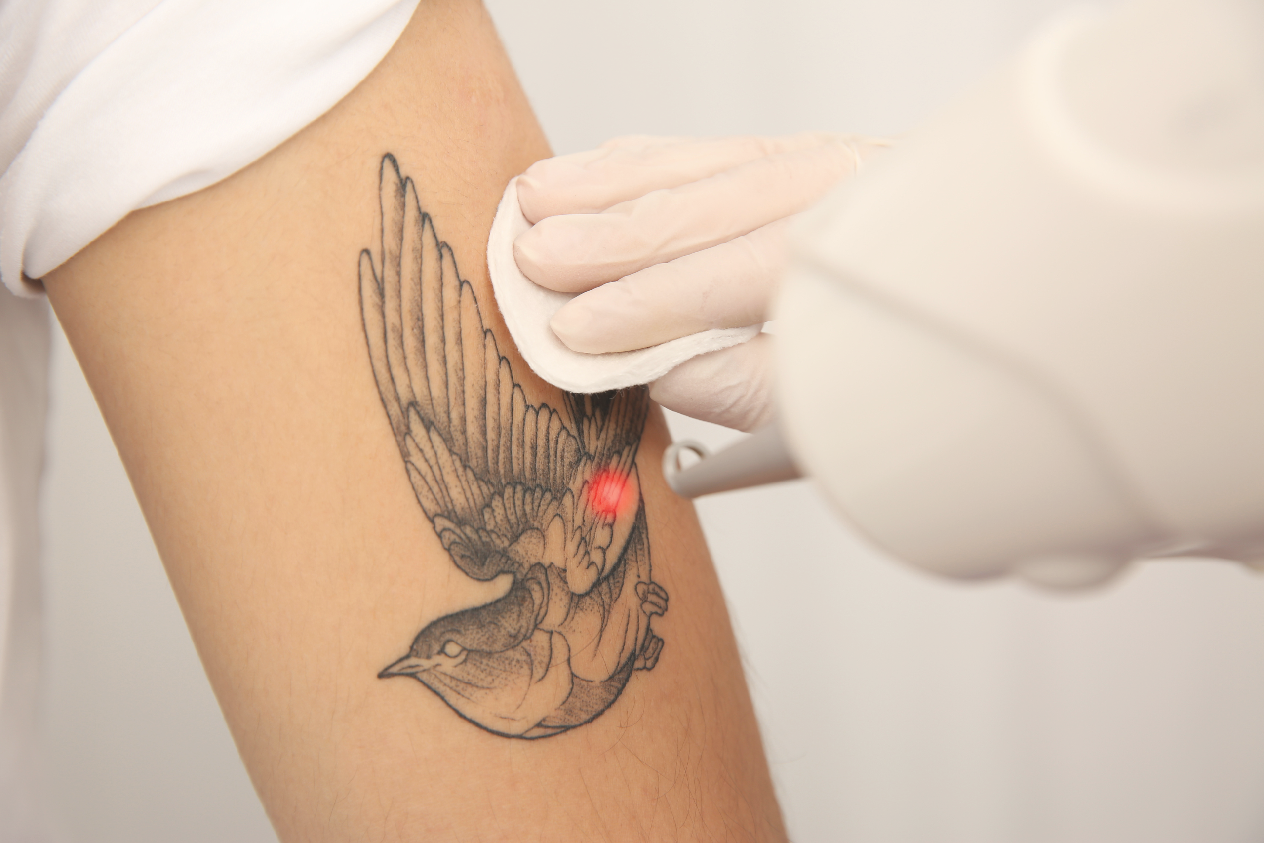 ADAP Tatoeage verwijdering voor huidtherapie