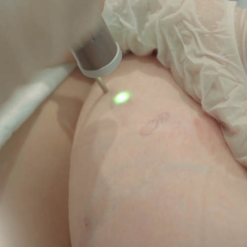 Asclepion Vascustar 2