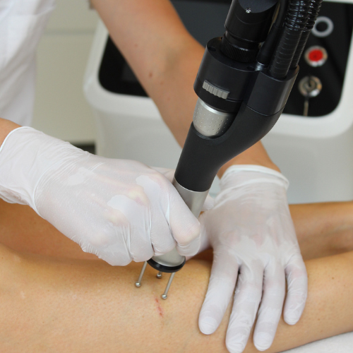 Dermablate 2
